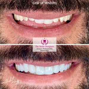 0001.-new-veneers-12-300x300