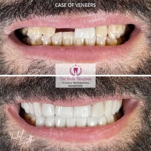 0001.-new-veneers-15a-300x300
