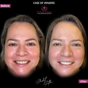 0001.-new-veneers-24b-300x300