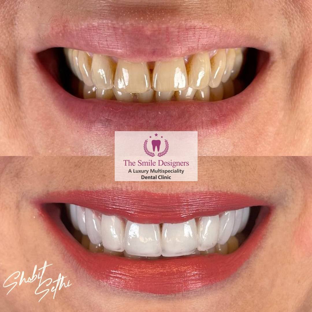 teeth whitening in india