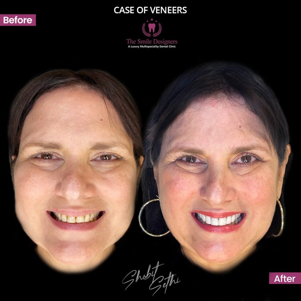 international patient veneers