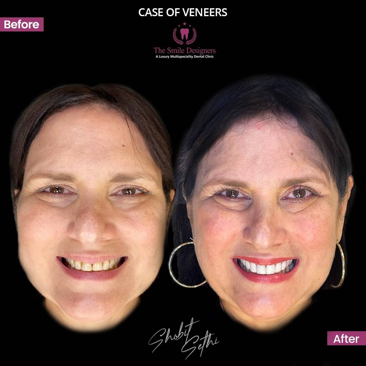 international patient veneers