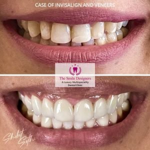 0001.-new-veneers-3-300x300