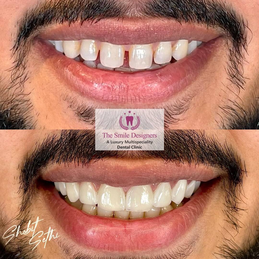 the dental tourism - the smile designers