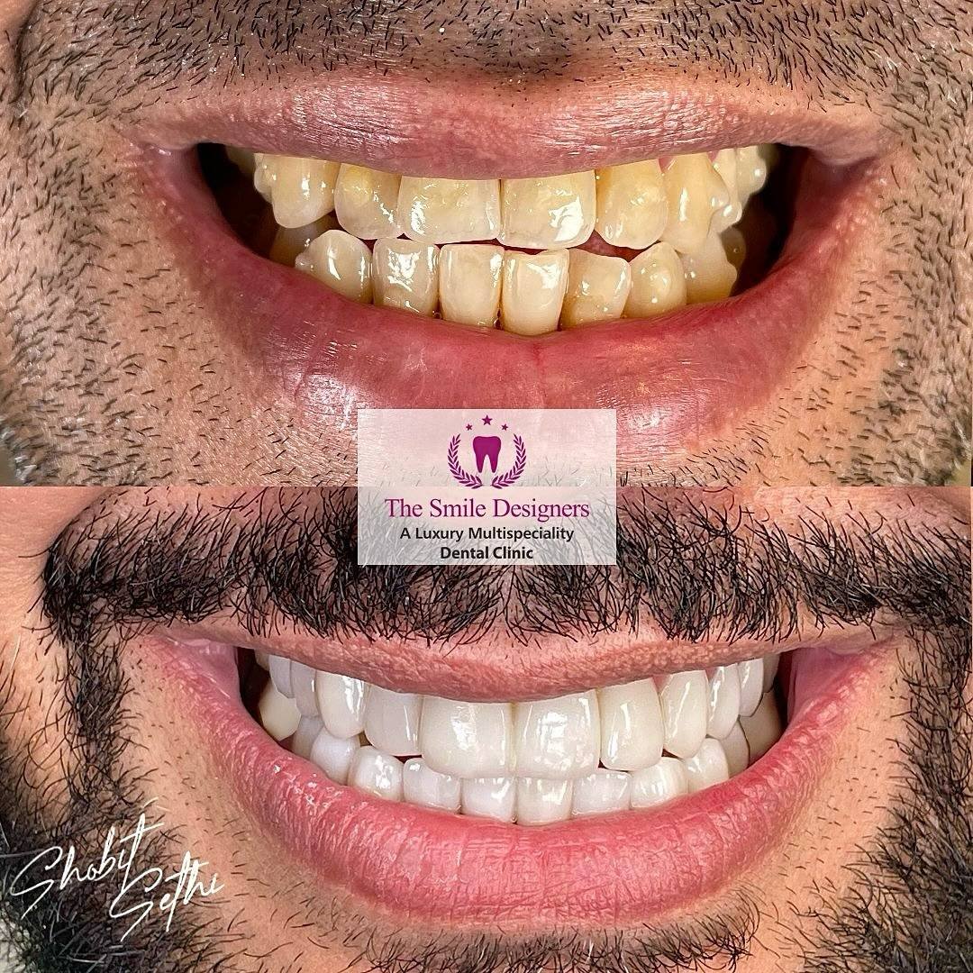 cheapest country in the world for dental treatment