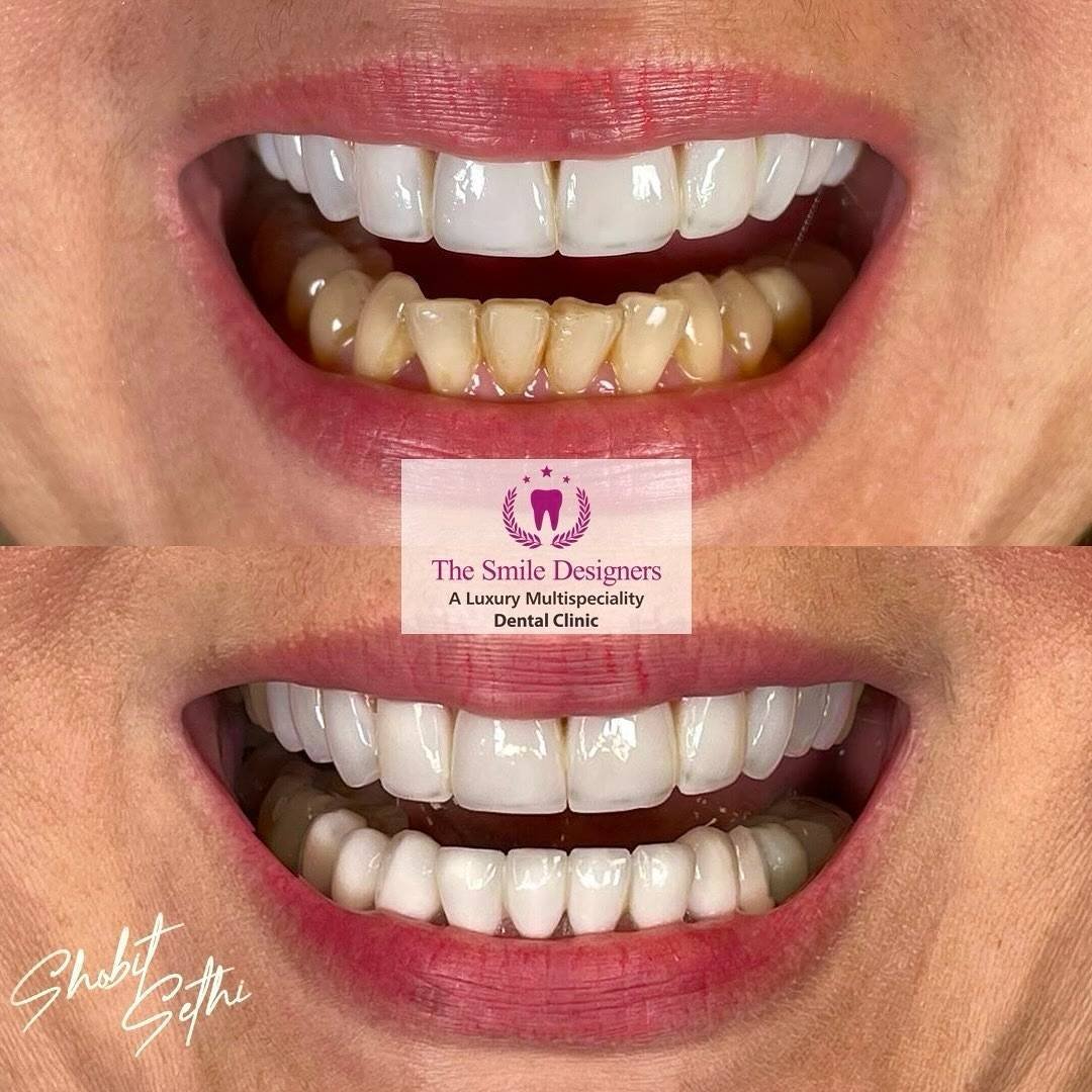 world's best veneer specialist