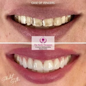0001.-new-veneers-7-300x300