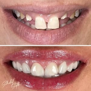 0001.zahida-veneerclose-up-300x300