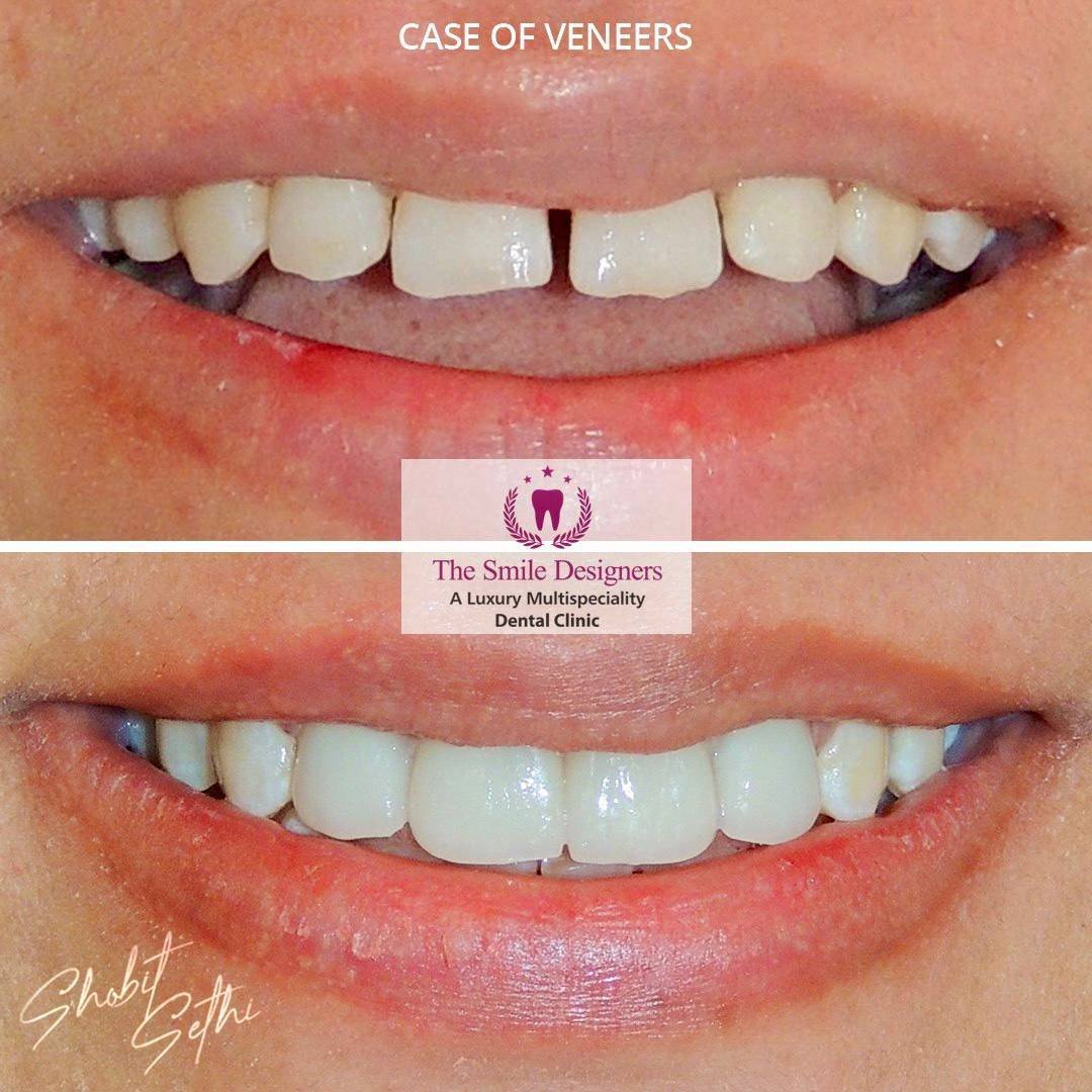 cheapest country for dental implants