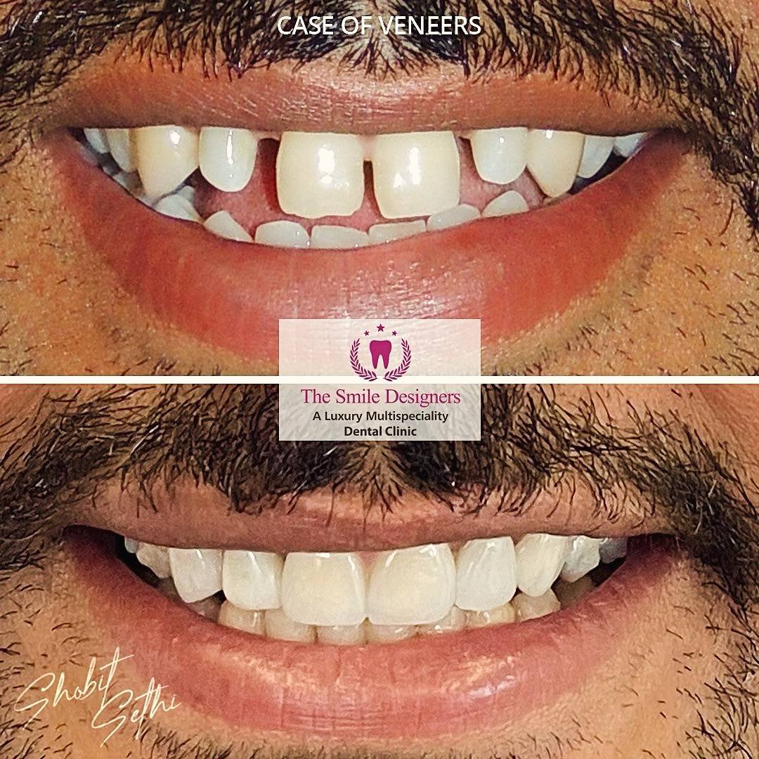 world's best teeth gap remover specialist