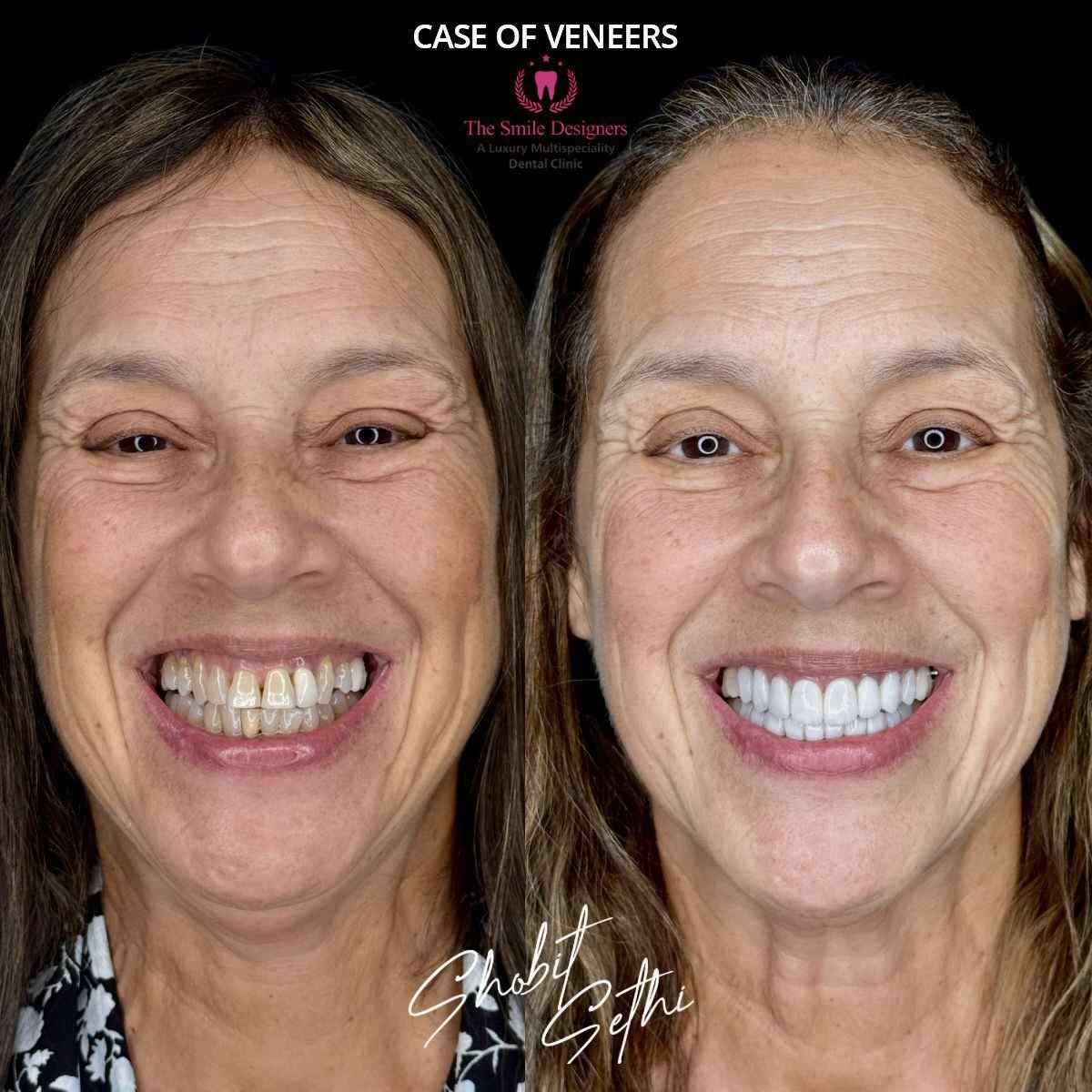 1veneers