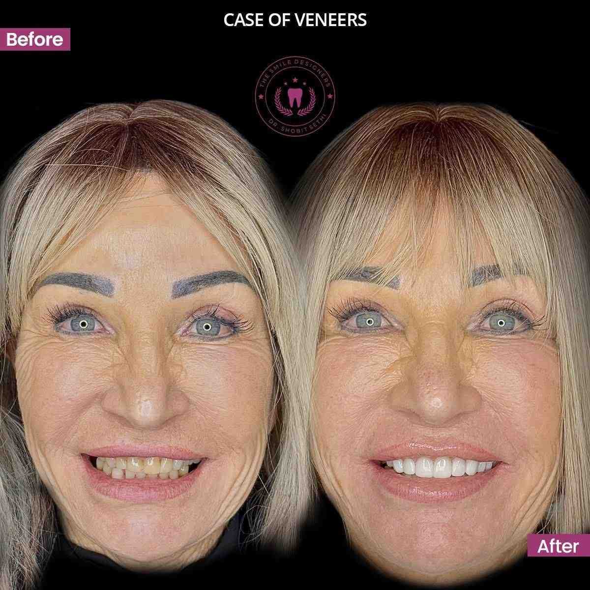 2veneers