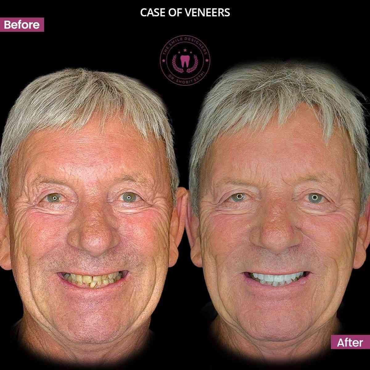 3veneers