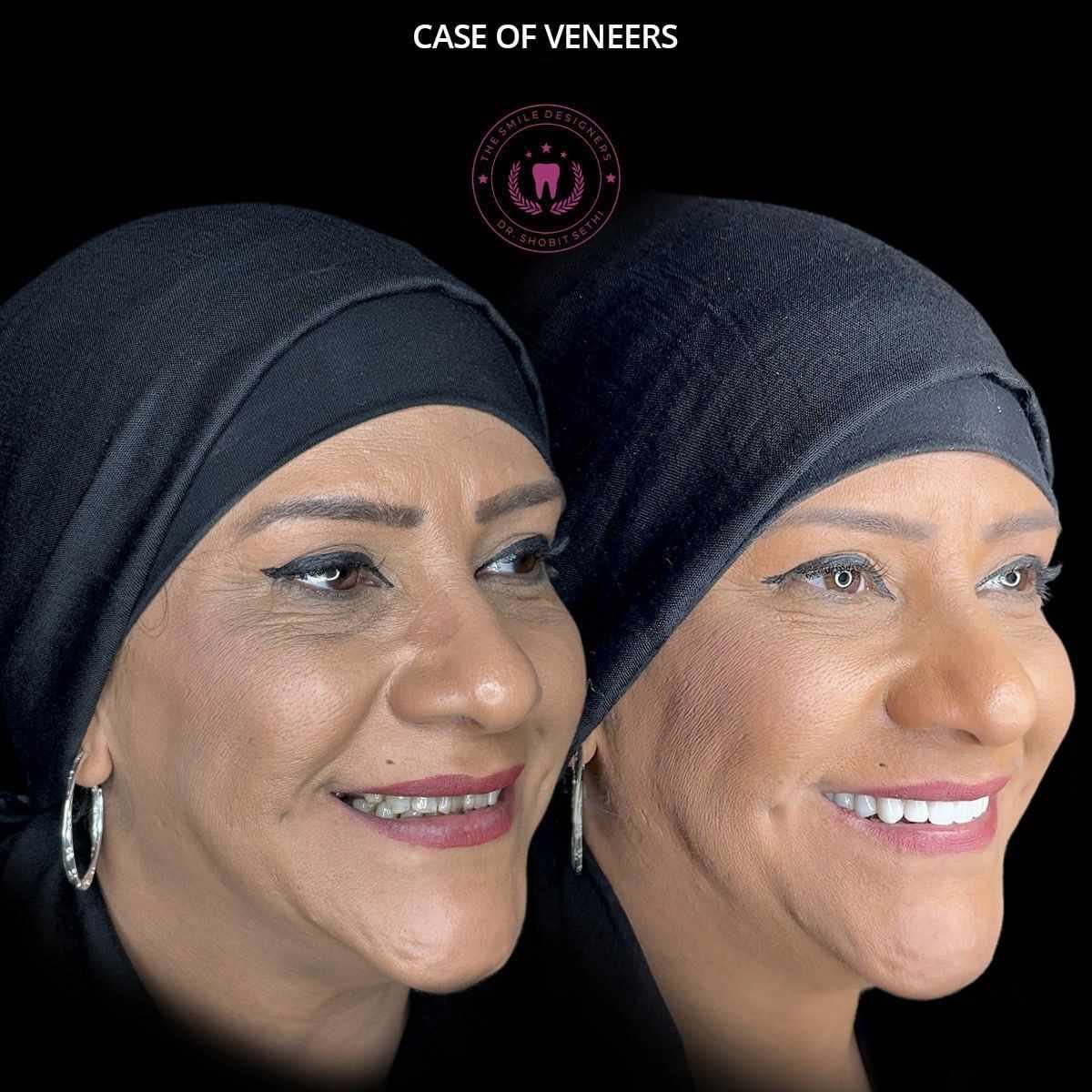 4veneers