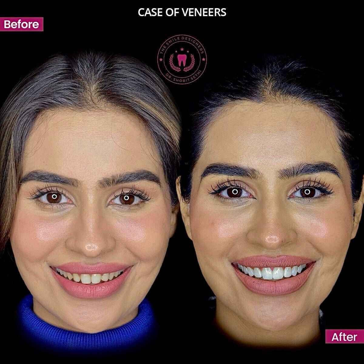 6veneers
